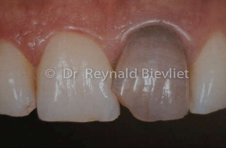 blanchiment interne et facette avant