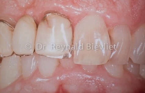 greffe gingivale et nouvelles prothèses avant