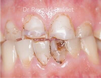 traitement esthétique dentaire avant