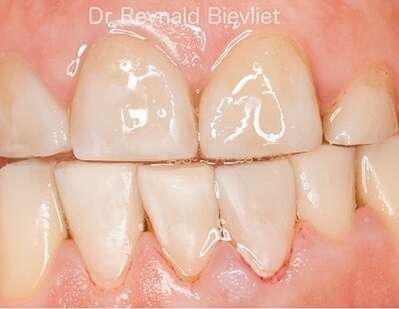traitement esthétique dentaire après
