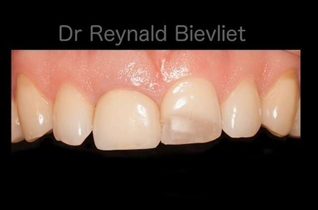 traitement esthétique dentaire avant