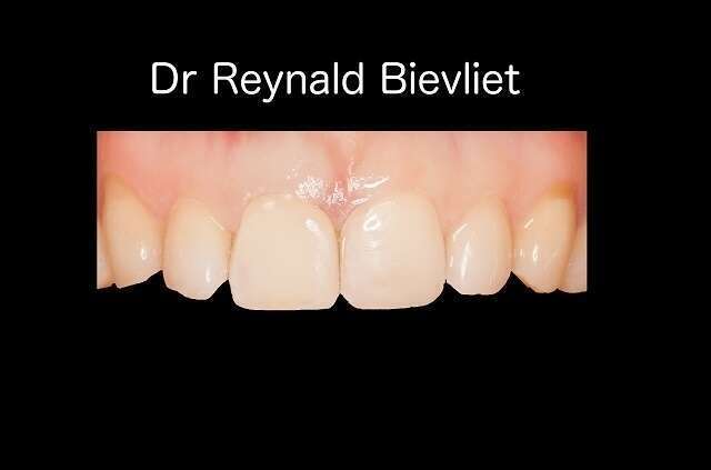 traitement esthétique dentaire après