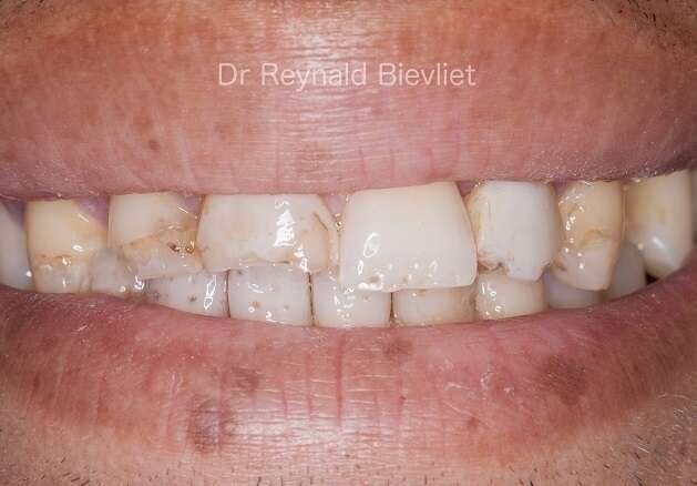 traitement esthétique dentaire avant