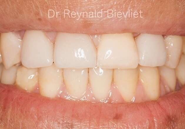 traitement esthétique dentaire après