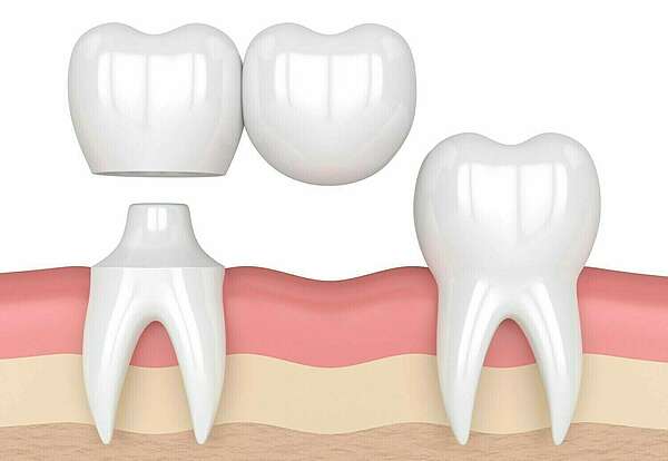 Bridge cantilever et bridge collé