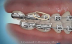 Correction avec élastique classe 3.