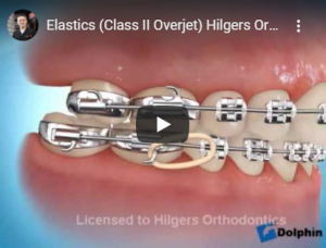 Correction avec élastique classe 2.