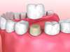Prothèses dentaires