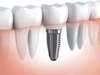 Implant dentaire et implantologie