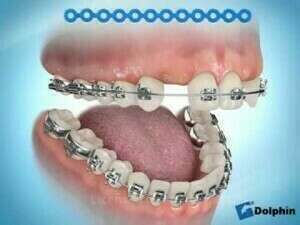 Traitement d’agénésie des incisives latérales par fermeture des espaces