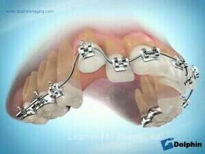 Première prémolaire 1