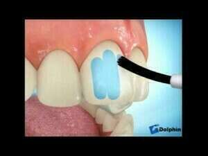 Collage des brackets