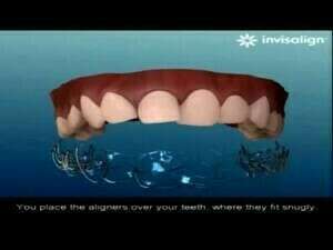 Traitement Invisalign