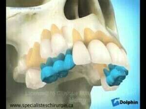 Chirurgie orthognatique