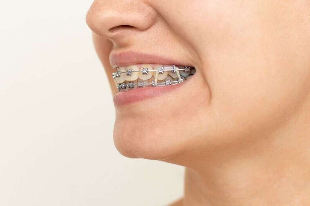 Les élastiques en orthodontie