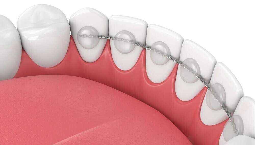 La période de contention orthodontique