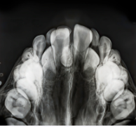 SOLUTIONS CONCERNANT LES MALPOSITIONS INESTHETIQUES DES DENTS