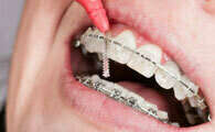 ORTHODONTIE ET HYGIENE BUCCO-DENTAIRE