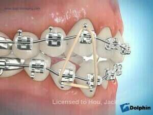 Elastics delta canine open bite