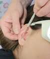 oreille avec laser froid en action sur points réflexes