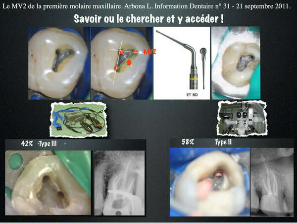 LE MV2 DE LA PREMIERE MOLAIRE MAXILLAIRE
