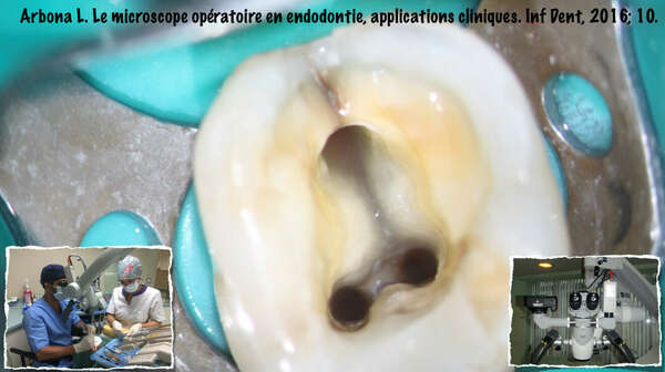 LE MICROSCOPE OPERATOIRE EN ENDODONTIE