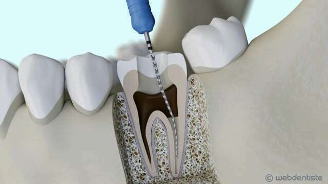 Protocole de dévitalisation d'une dent ou traitement endodontique