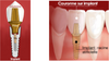 implants1