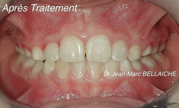 CAS CLINIQUES - AVANT/APRÈS - ORTHODONTISTE PARIS 18