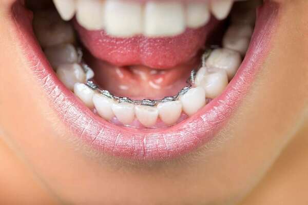 ORTHODONTIE DE L'ADULTE: LA TECHNIQUE LINGUALE