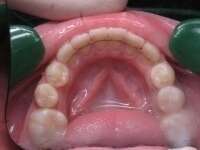 LES FILS DE CONTENTION - PARIS