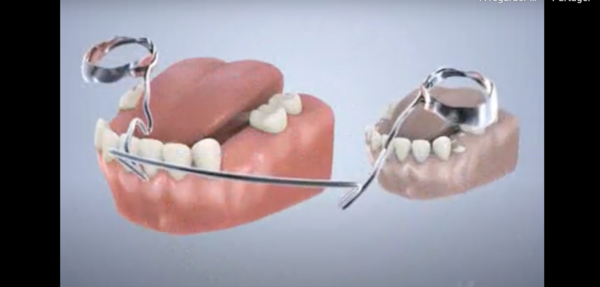 Arc lingual (mainteneur d'espace)