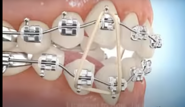 Elastique d'intercuspidation