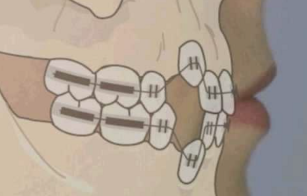 Traitement orthodontique avec extractions, pour la correction d’une malocclusion de Classe I avec DDM