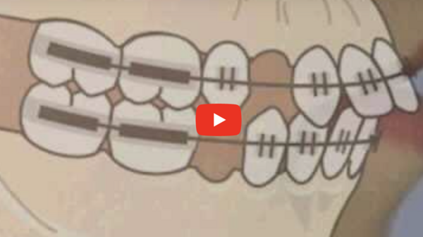 Traitement orthodontique avec extractions, pour la correction d’une malocclusion de Classe II avec bi-protrusion