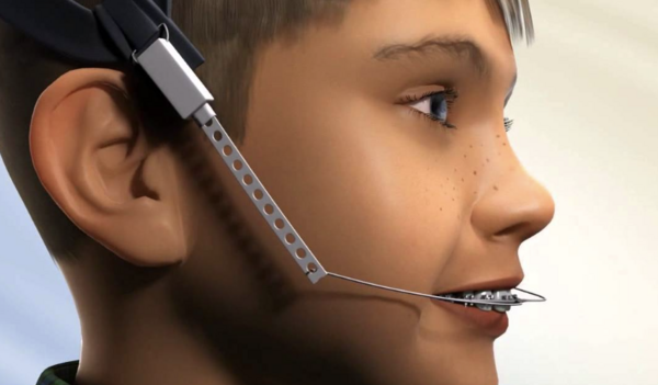 Les différentes forces extra-orales