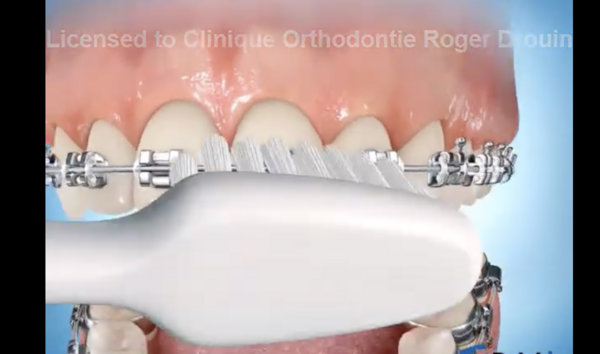 Brossage des dents avec des brackets
