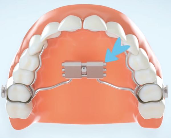 Comment activer son disjoncteur maxillaire ?