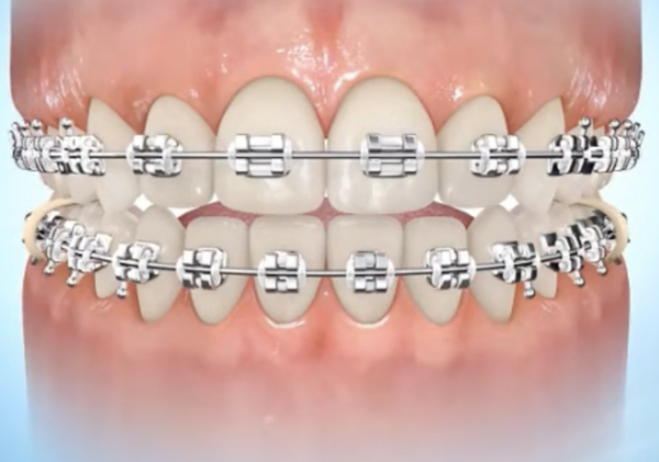 Élastique pour occlusion croisée