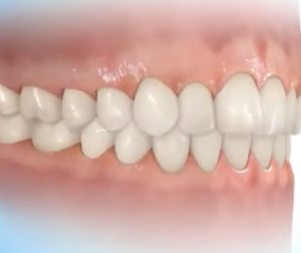Traitement orthodontique par gouttières transparentes