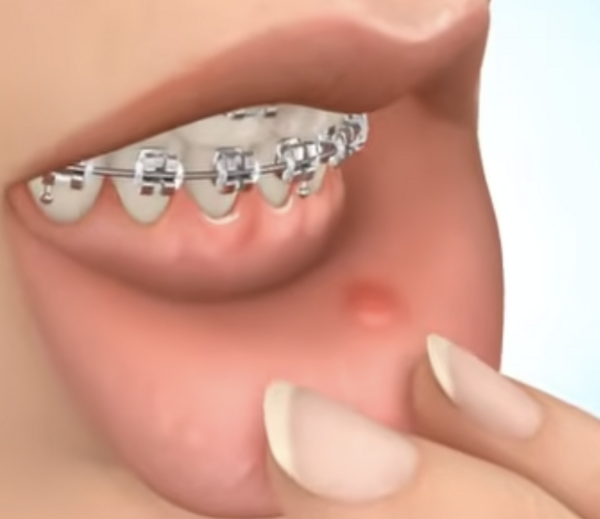 Cire de protection orthodontique