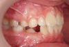 Cas clinique d’orthodontie adolescent Le Mans