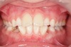 Cas clinique d’orthodontie adolescent Le Mans