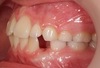 Cas clinique d’orthodontie adolescent Le Mans