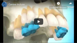 Canine incluse