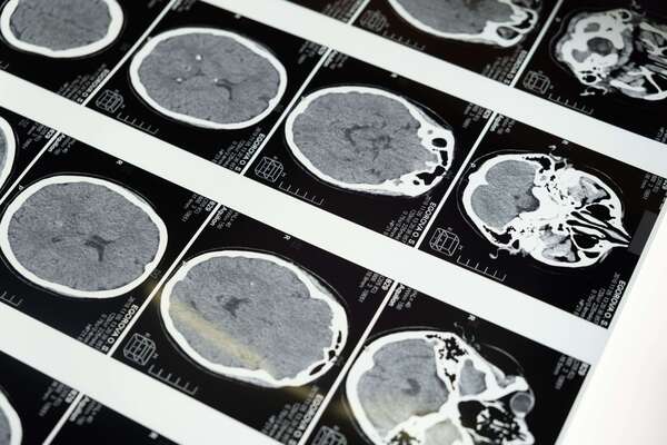 Vous n'arrivez pas à décrocher .... pourquoi votre cerveau reste en mode "alerte" ?