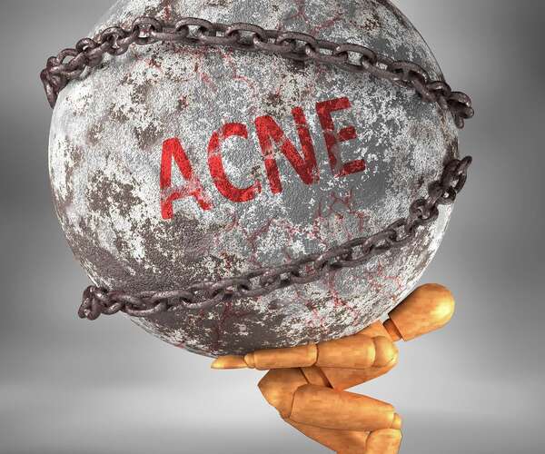 Acné à l’âge adulte : quel impact sur le moral ?