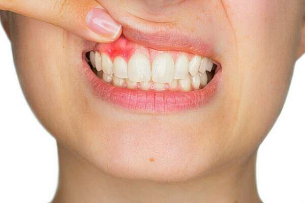 LES CONSEQUENCES DU NON-REMPLACEMENT DES DENTS EXTRAITES OU ABSENTES