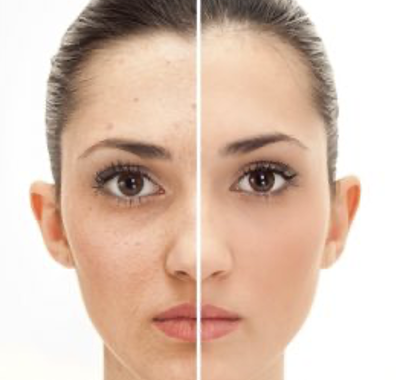 PRP, Plasma Riche en Plaquettes