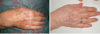 avant après traiement tache mains